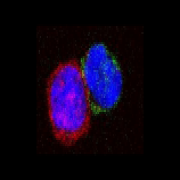 Neutrophil immune cells may serve as a target for new therapies and a biomarker for advanced-stage breast cancer